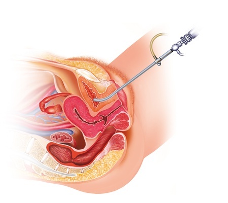 cystoscopy Plano urogynecology